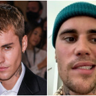 Justin Bieber paralysé du visage