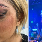 Bebe Rexha attaquée au visage, la vidéo choc