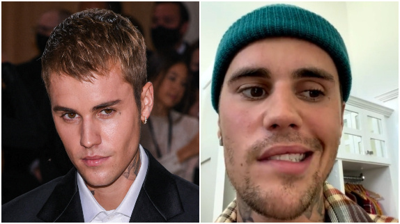 Justin Bieber paralysé du visage